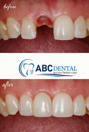 Before and After Implant