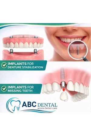 Dental Implants and Dentures