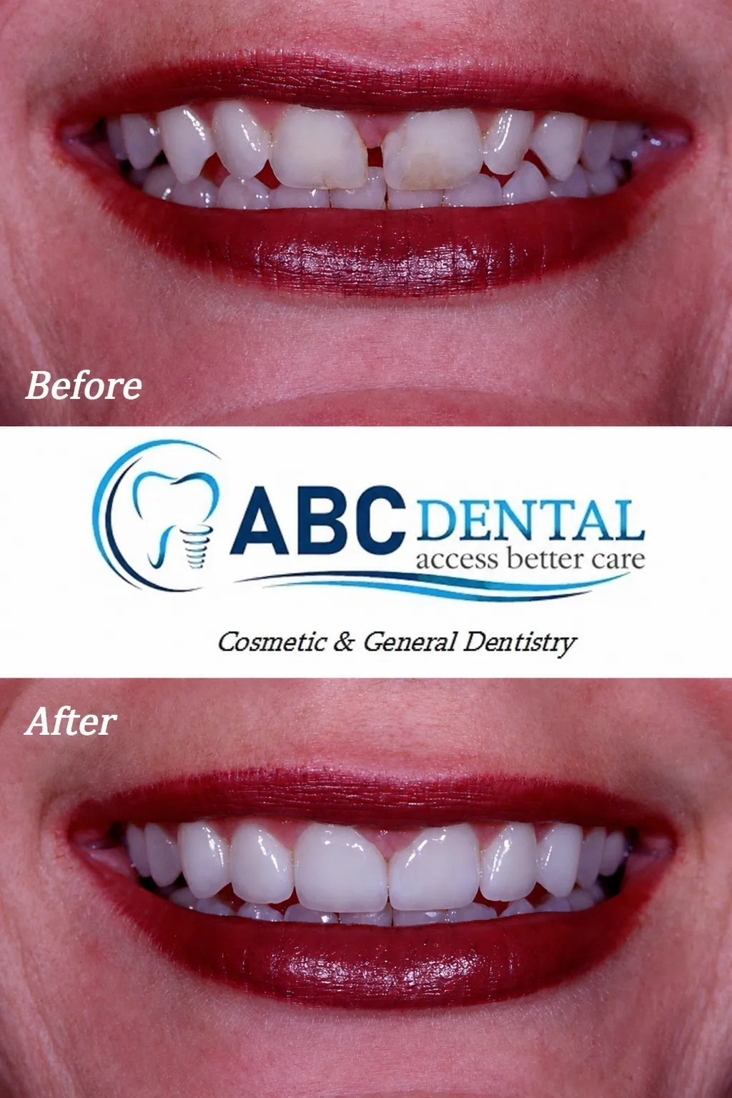 Before and after Four Anterior Veneer treatment at ABC Dental Group