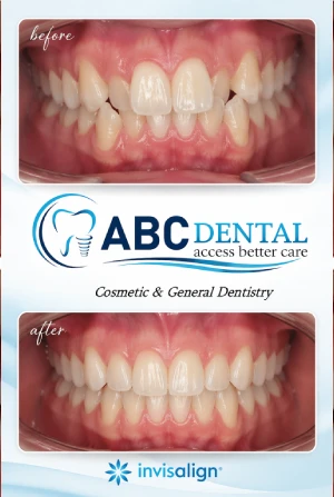 Before Invisalign - Crowded Teeth