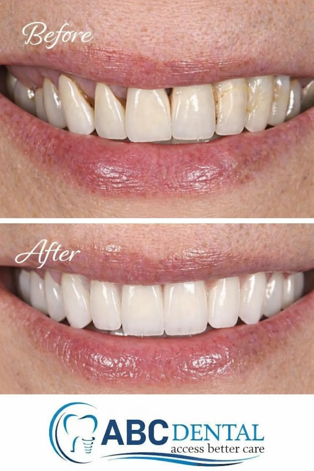Mary before and after cosmetic dental transformation at ABC Dental Group