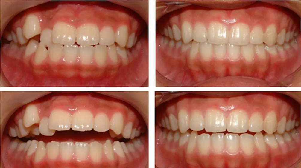 Before and After Orthodontics