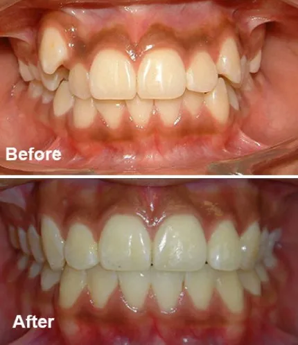 Before and After Orthodontics
