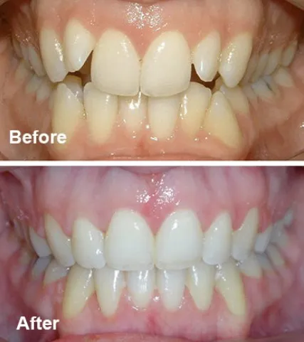 Before and After Orthodontics