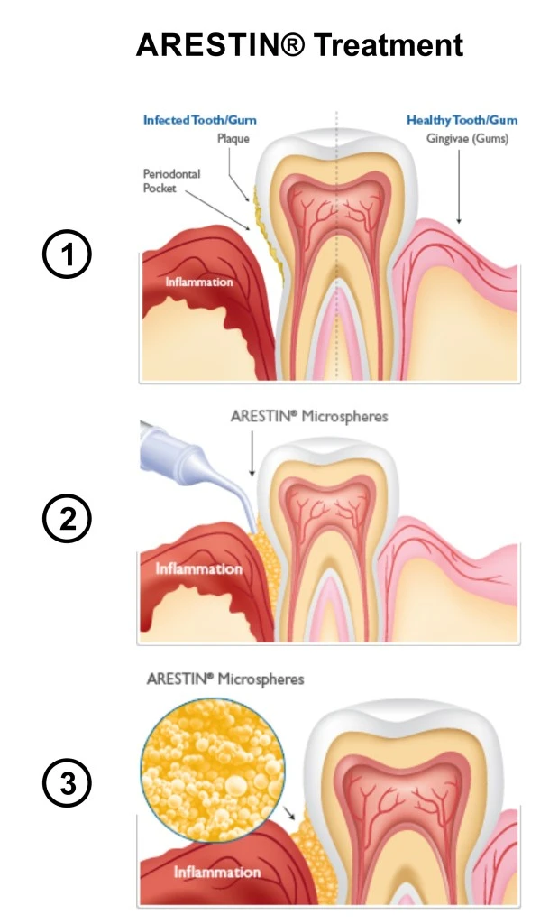 Periodontal Care in Antioch