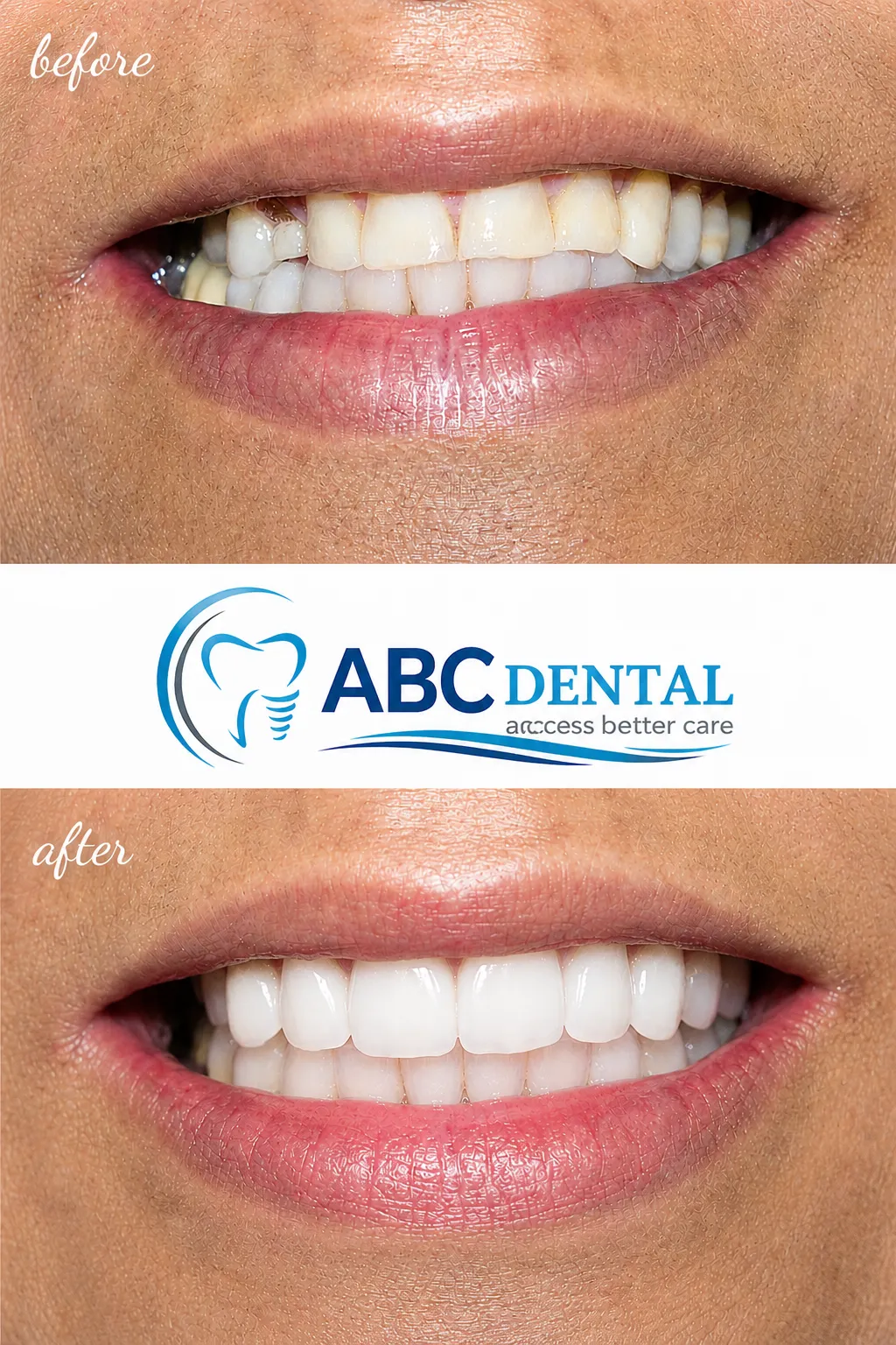 Rashida before and after cosmetic dental treatment at ABC Dental Group